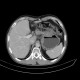 Stomach tumour: CT - Computed tomography